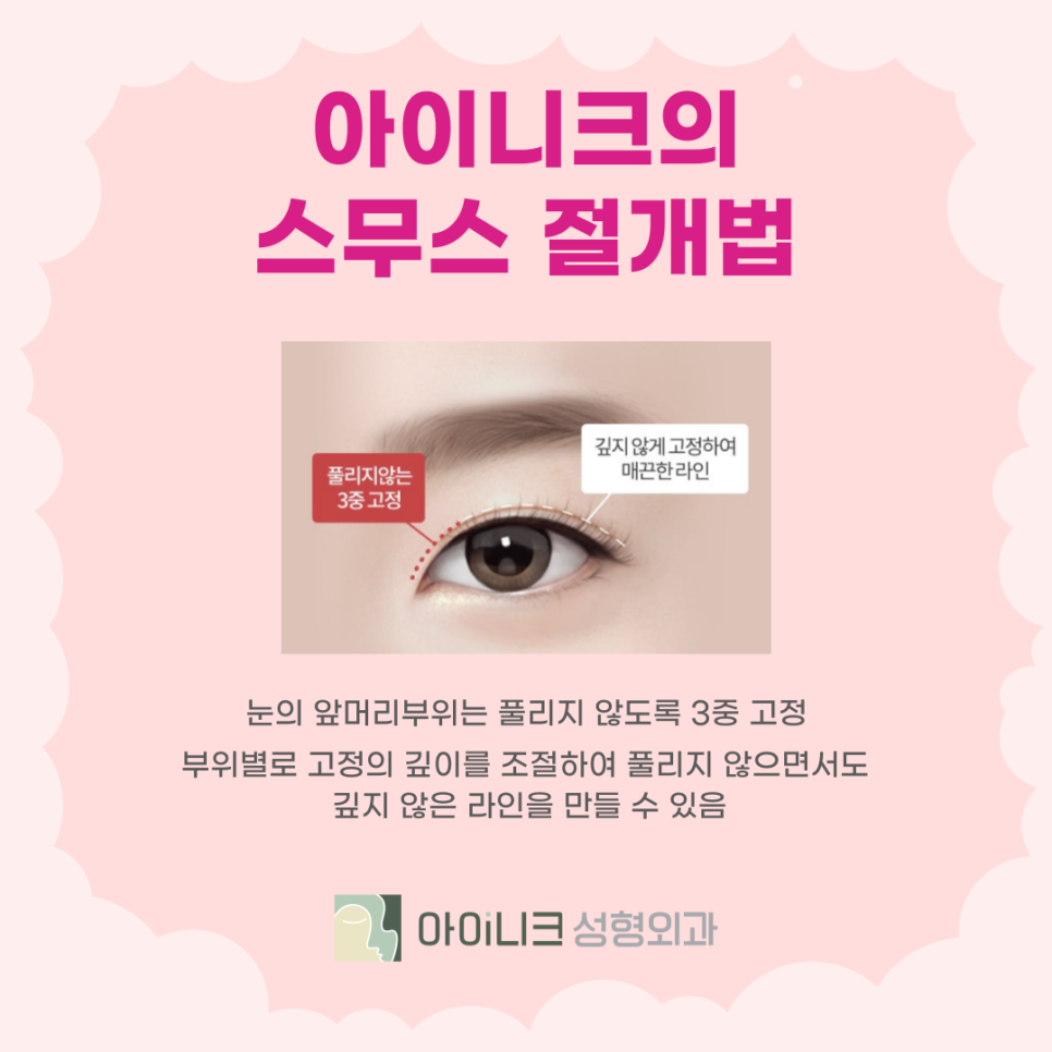 눈성형외과추천 자연스러움을 살리는 방법 관련 이미지 6