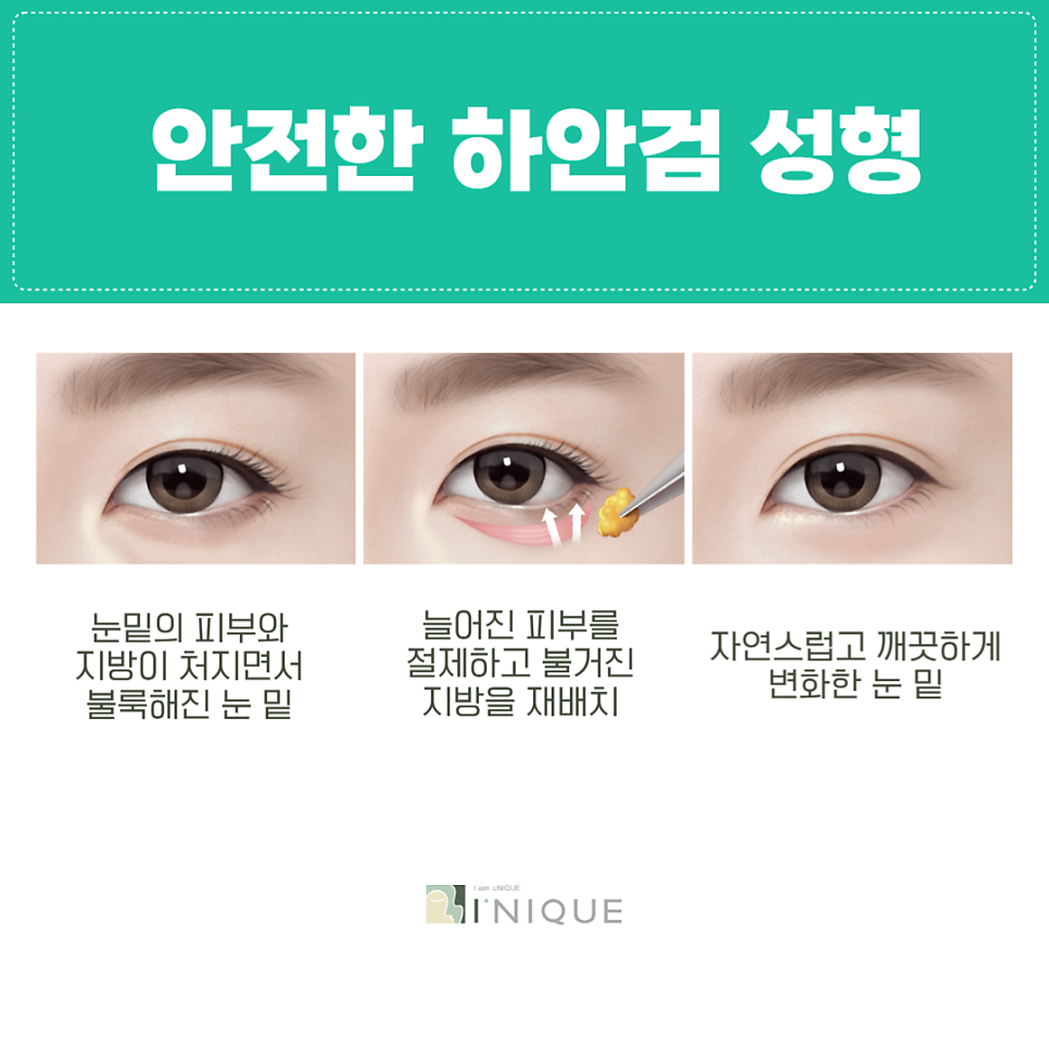 Is Double Eyelid Surgery in Your 50s the Right Choice? image 3