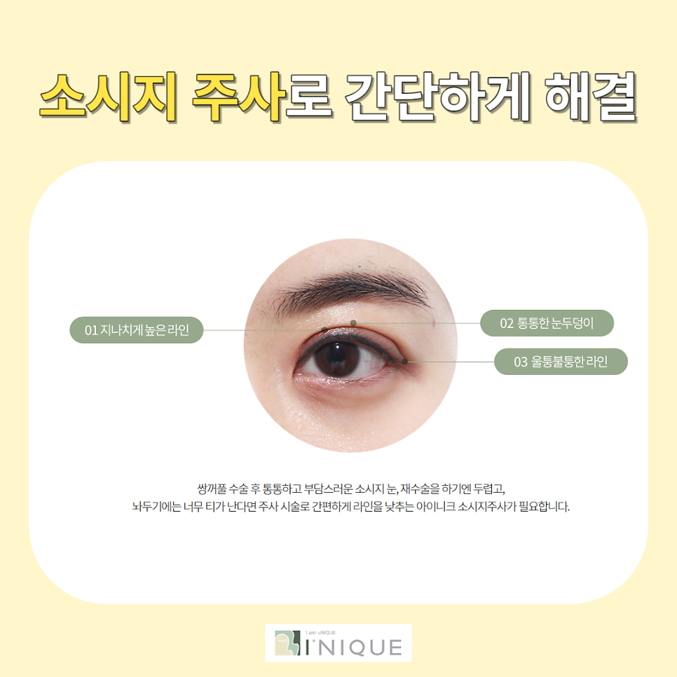 쌍수 후 관리 붓기 주사로 간편하고 안전하게! 관련 이미지 2