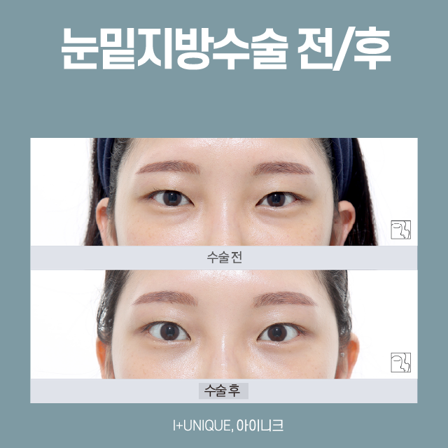 눈밑지방수술추천, 오늘 수술해도 내일 회복 가능한 바로 그것! 관련 이미지 4