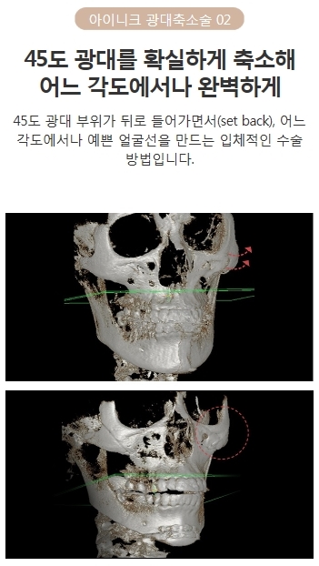 광대축소술가격 합리적인 곳 관련 이미지 4