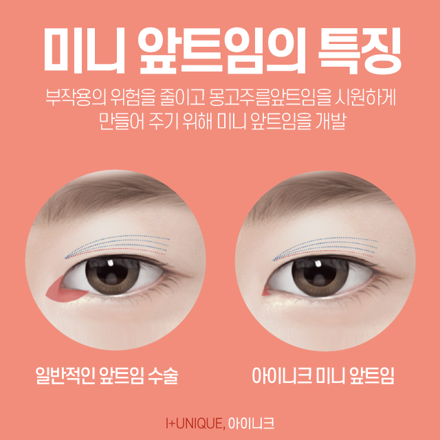 답답해 보이는 몽고주름앞트임, 시원하게 만들고 싶다면? 관련 이미지 4