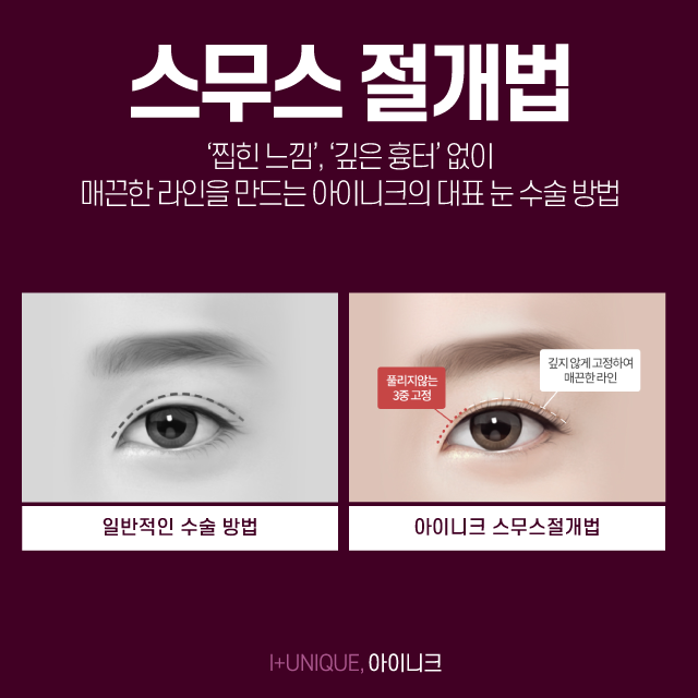 부작용 없는 압구정쌍수성형외과를 찾는다면? 관련 이미지 3