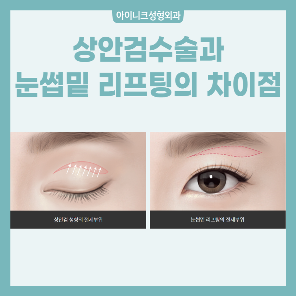 중년눈수술, 젊은 눈으로 되돌리고 싶다면? 관련 이미지 5