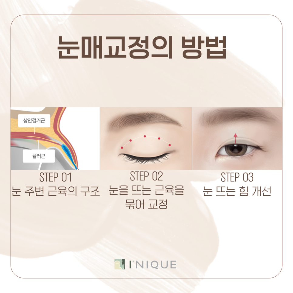 남성눈성형 느끼하지 않은 깔끔한 인상으로 관련 이미지 5