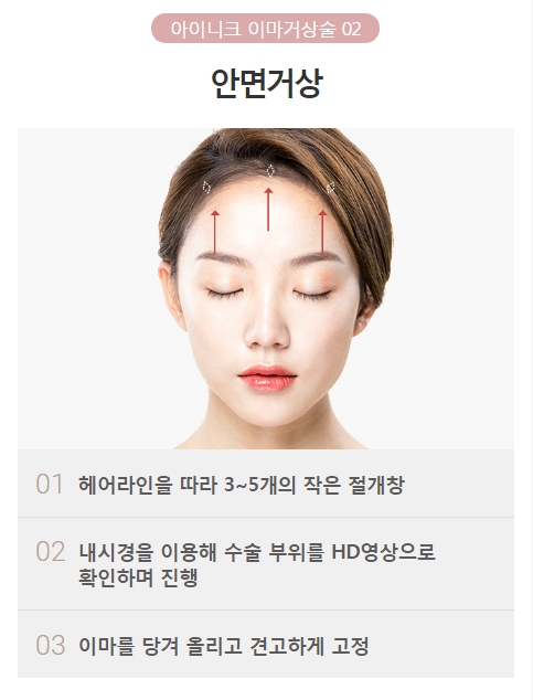 내시경이마거상술 깊은 주름과 처진 눈가를 한 번에! 관련 이미지 4