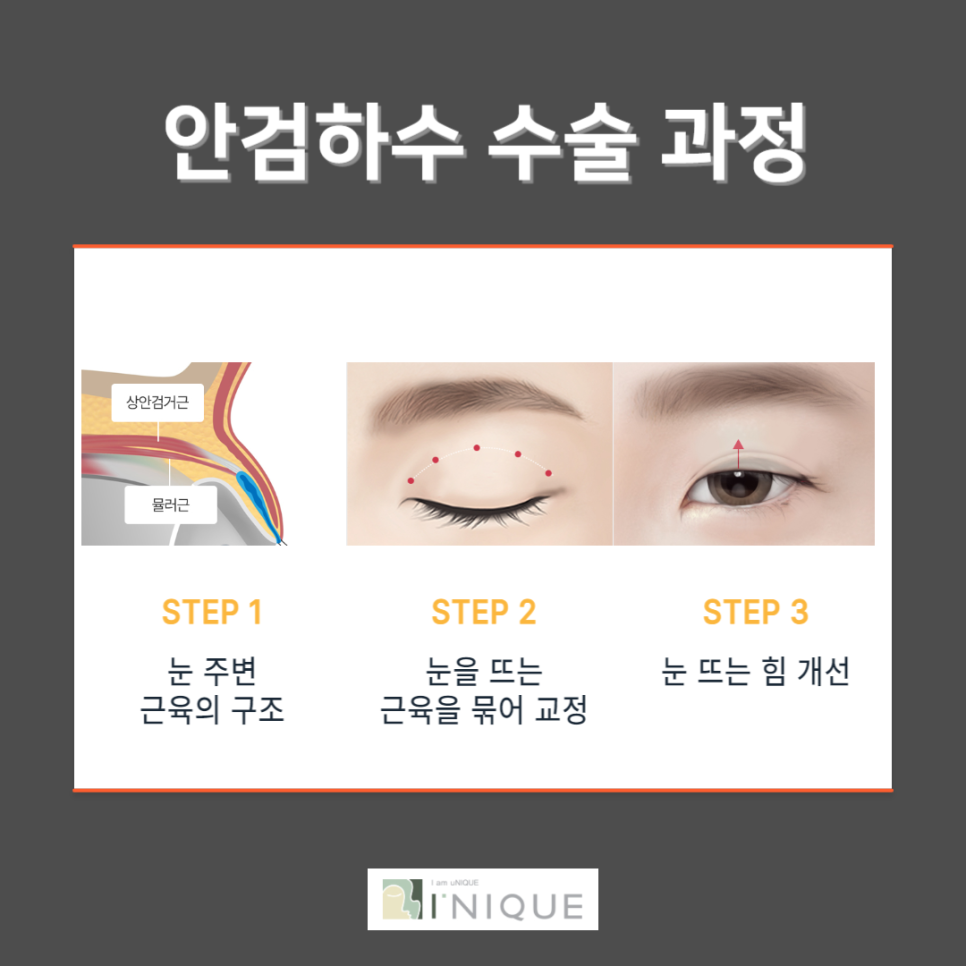 눈처짐해결에 가장 효과적인 방법! 관련 이미지 4