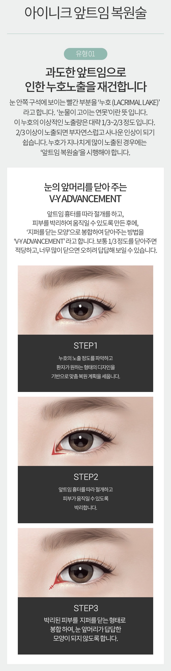 앞트임복원수술로 자연스럽게 예뻐지자! 관련 이미지 4
