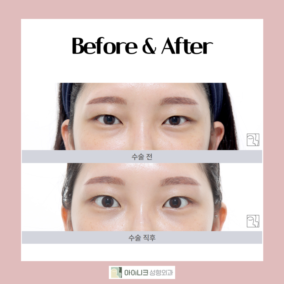 눈밑지방재배치잘하는병원을 찾고계시나요? 관련 이미지 4