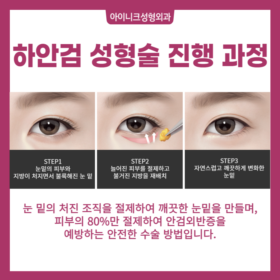 Lower Blepharoplasty for the Under-Eye Area, Safe and Successful image 5