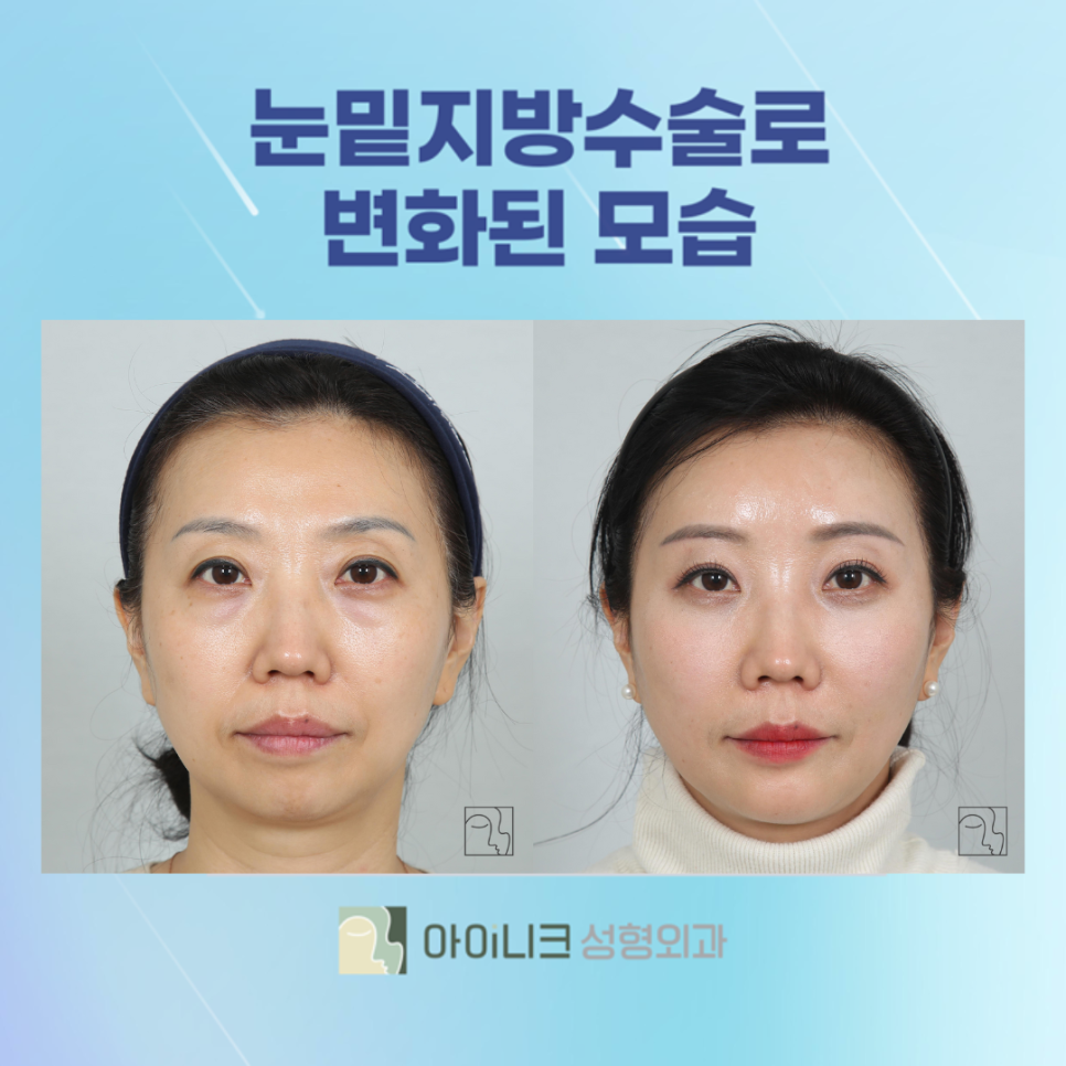 Brighten Your Face Without Dark Circles with Lower Eyelid Surgery! image 7
