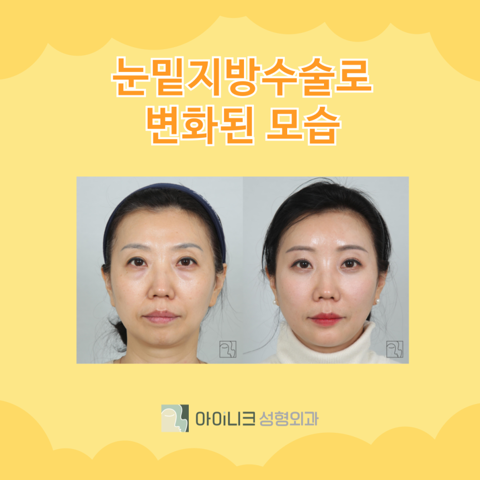 눈밑지방재배치수술병원 제대로 선택하기 관련 이미지 7