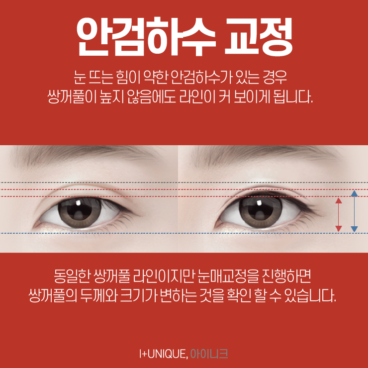 유명한 눈재수술명의를 찾고 있다면 아이니크성형외과로 관련 이미지 5