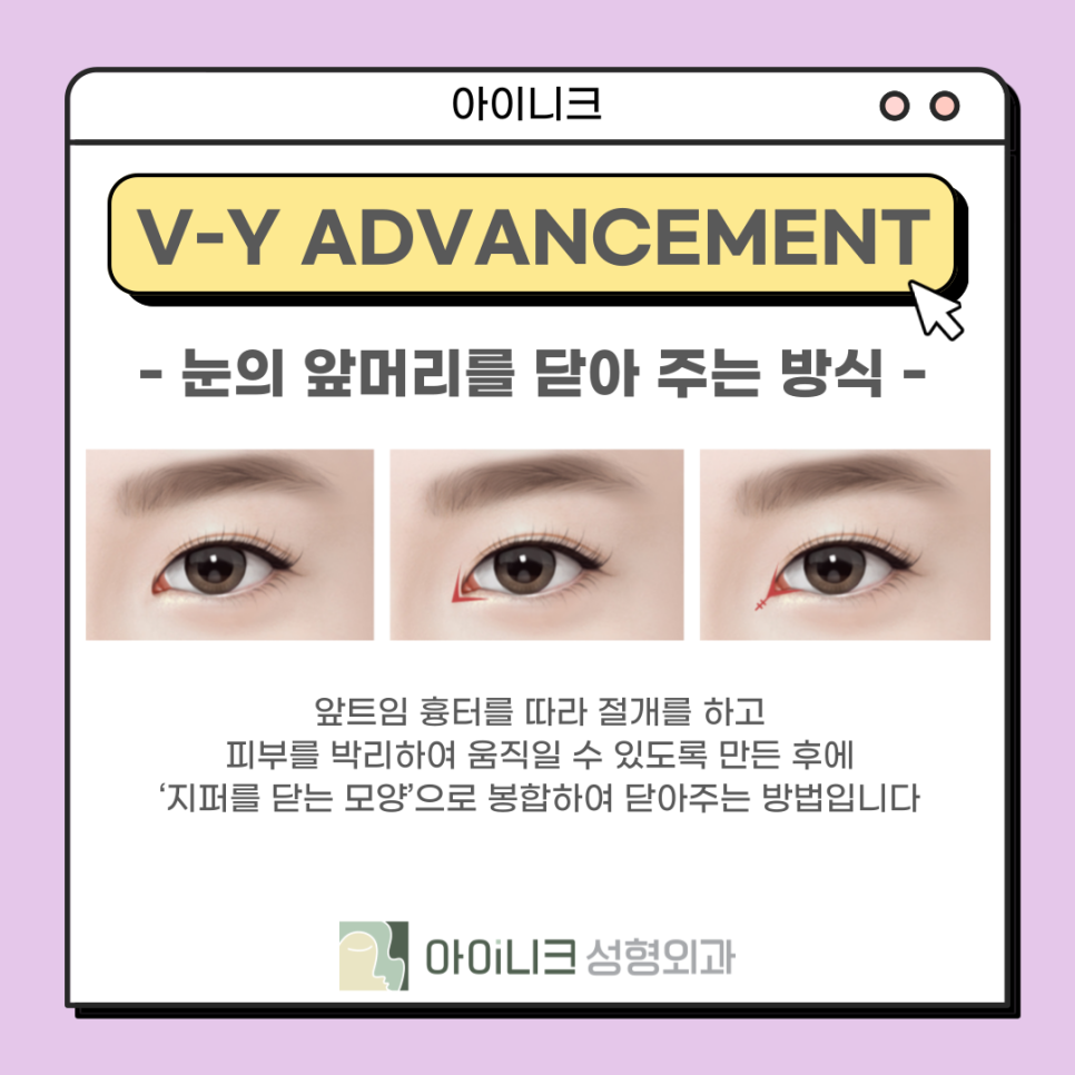 눈재수술성형외과 실패한 앞트임 재건 관련 이미지 11