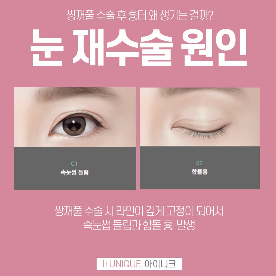 성형외과재수술을 알아보고 있다면 이젠 결정하자 아이니크로! 관련 이미지 2