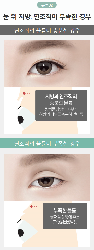 쌍커풀여러겹이 생겨 고민이라면 아이니크로! 관련 이미지 4