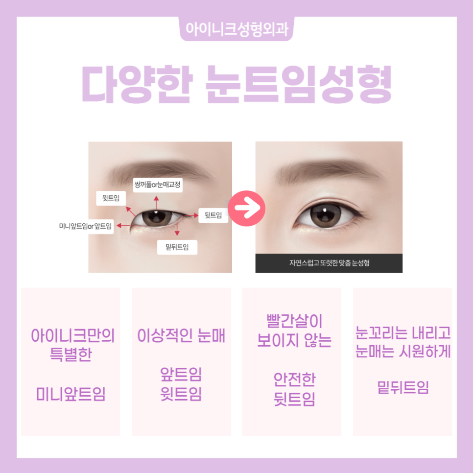 눈트임성형 자연스럽고 아름답게! 관련 이미지 2