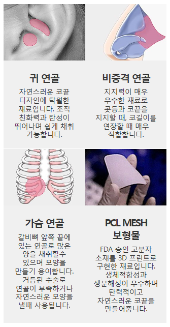 코보형물종류 나에게 맞는 걸로 선택하자 관련 이미지 5