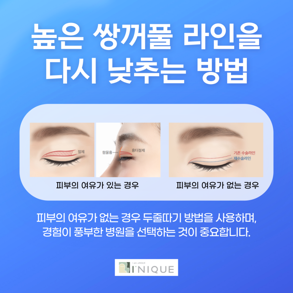 쌍커풀재수술잘하는곳 맞춤으로 자연스럽게 관련 이미지 3