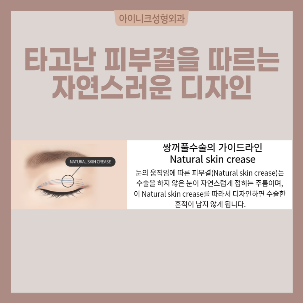 연예인눈성형처럼 자연스럽고 싶다면? 관련 이미지 5