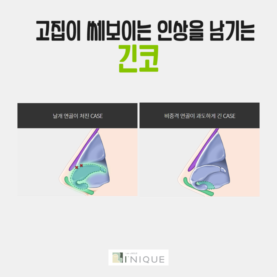 흰코성형이 고민이라면 주목! 관련 이미지 4