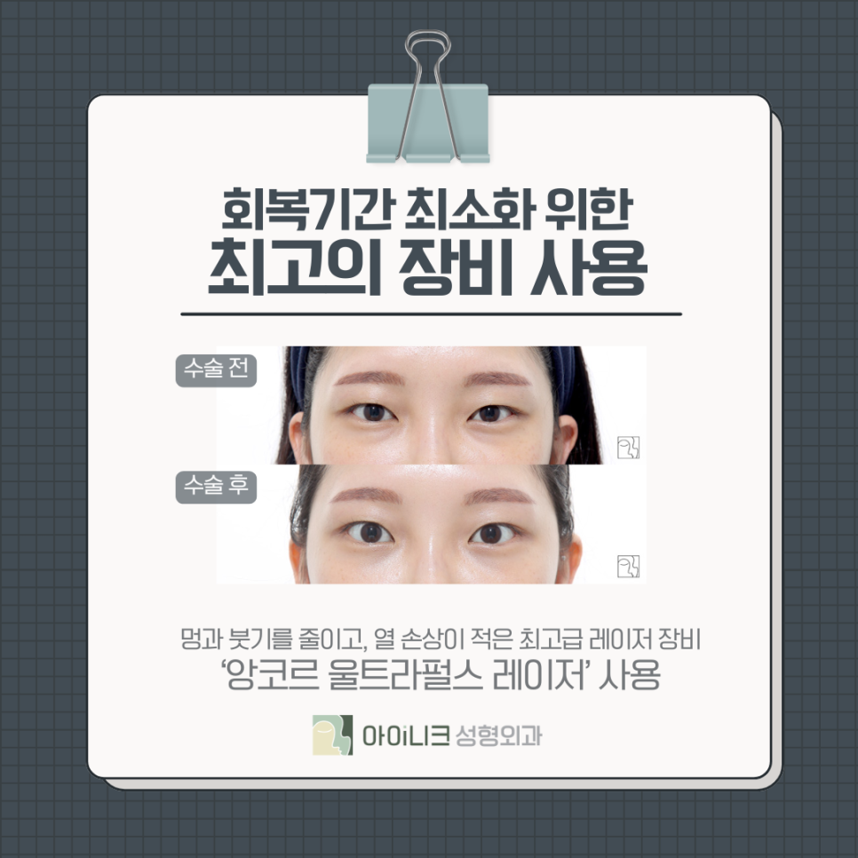 동안을 꿈꾼다면 앙코르눈밑지방재배치 관련 이미지 6