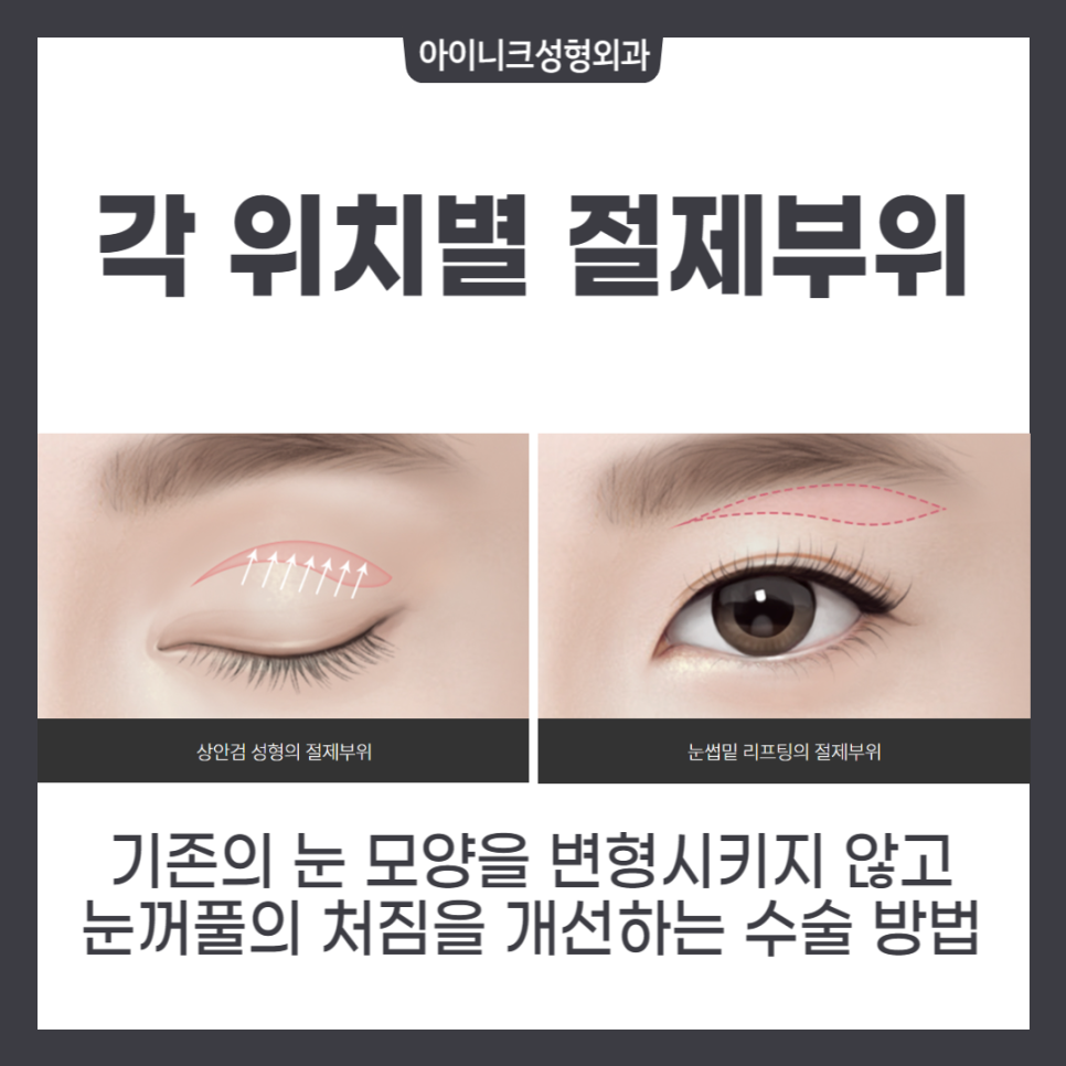 중년성형, 다시 20대의 눈매로 관련 이미지 3