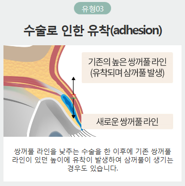 쌍커풀여러겹이 생겨 고민이라면 아이니크로! 관련 이미지 5