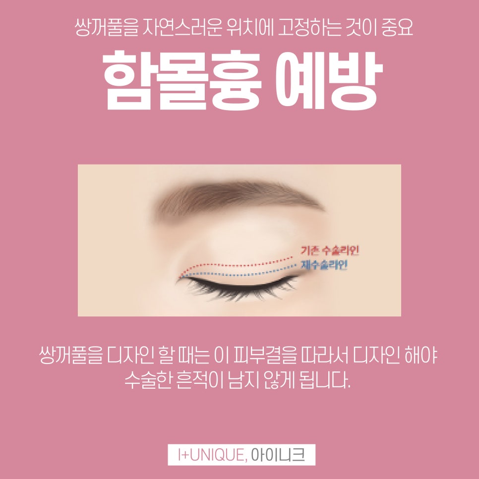 성형외과재수술을 알아보고 있다면 이젠 결정하자 아이니크로! 관련 이미지 4