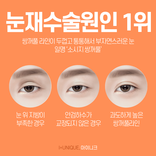 소시지눈재수술 고민한만큼 신중하게! 관련 이미지 2
