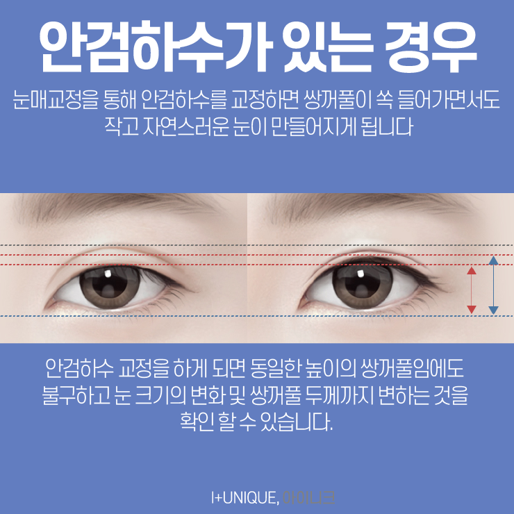 쌍꺼풀라인낮추기 방법을 알아보고 있다면 아이니크성형외과에서상담받자 관련 이미지 4