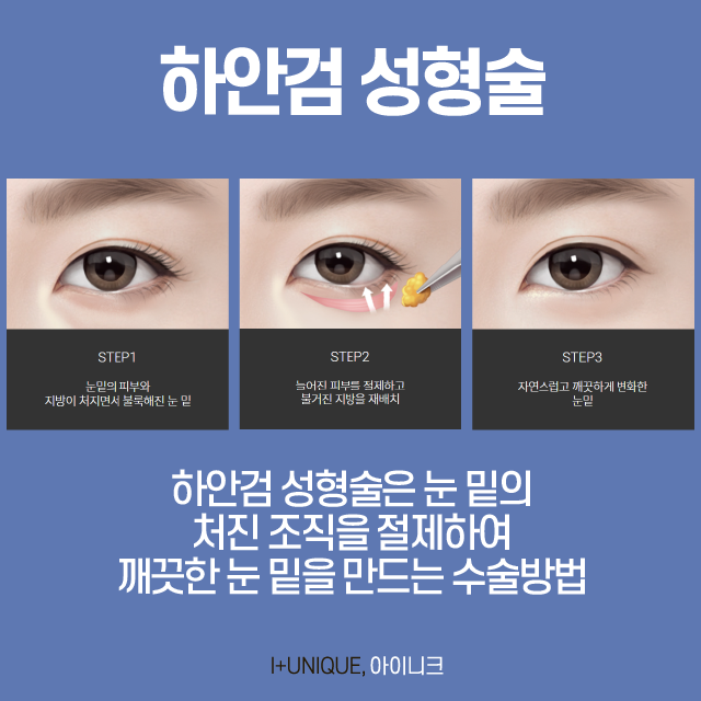 40대눈성형 고민하고 있다면? 관련 이미지 4