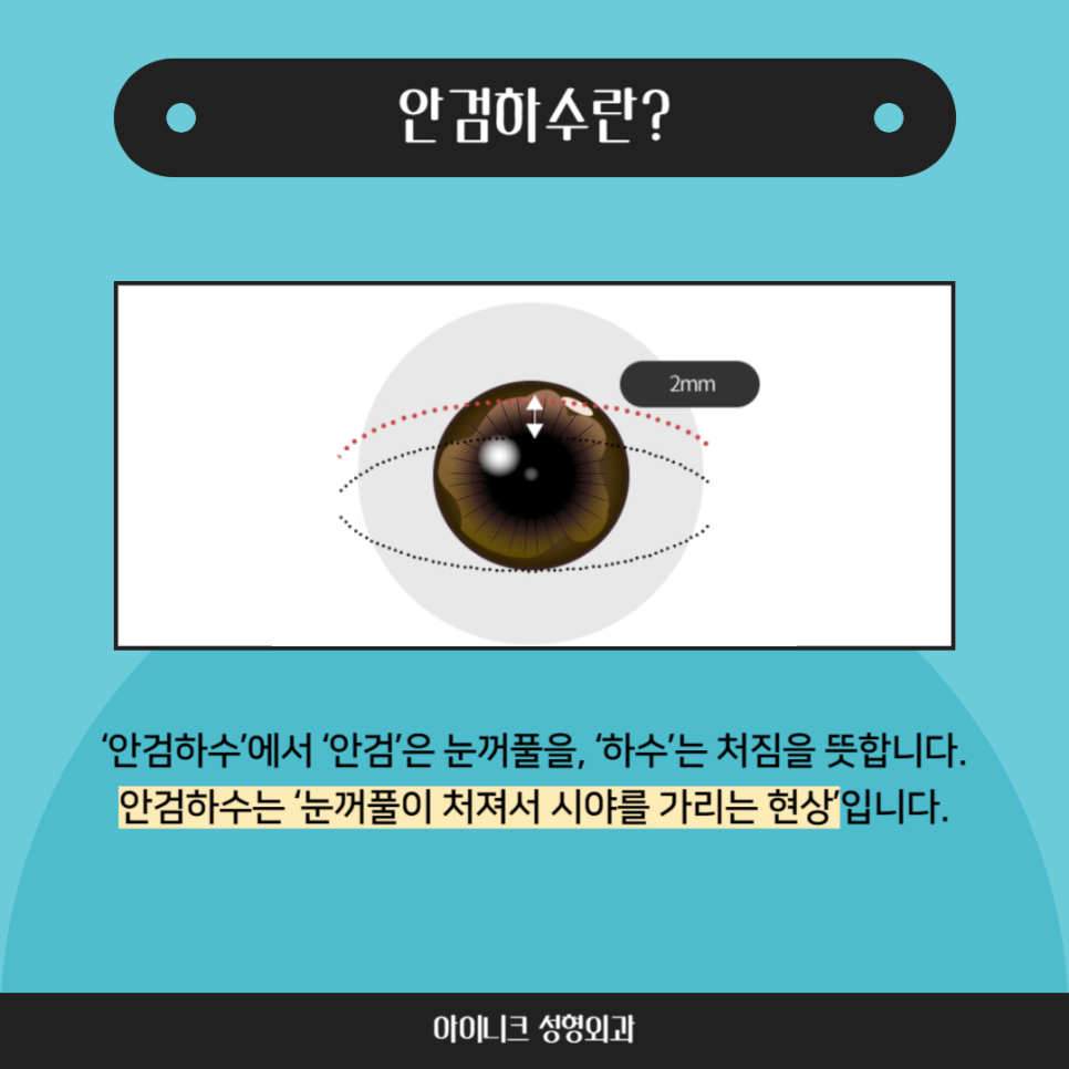 눈처짐 수술, 일반 쌍수랑 무엇이 다를까? 관련 이미지 2
