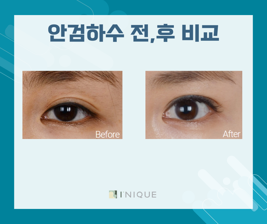 쌍수재수술추천 적절한 시기와 방법 관련 이미지 5