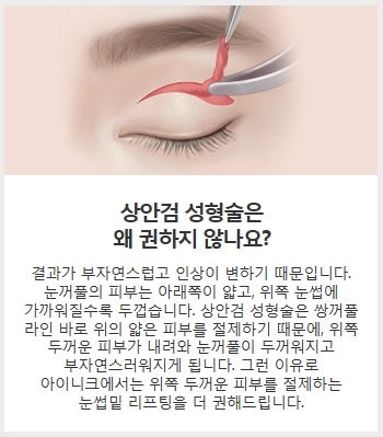 중년눈매교정 안전한 수술법으로 관련 이미지 5