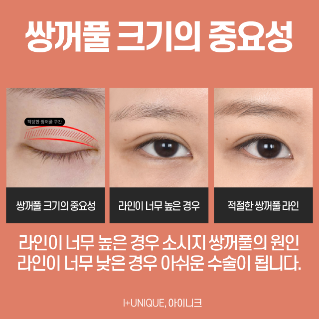여자눈성형 가장 중요한 포인트는 이것 관련 이미지 3