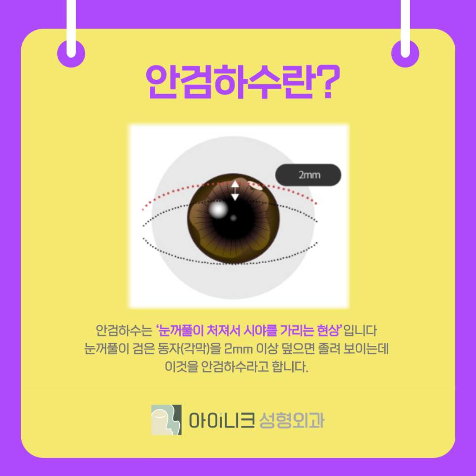 What Is the Non-Incisional Eye Correction Method at a Gangnam Eye Surgery Clinic? image 4