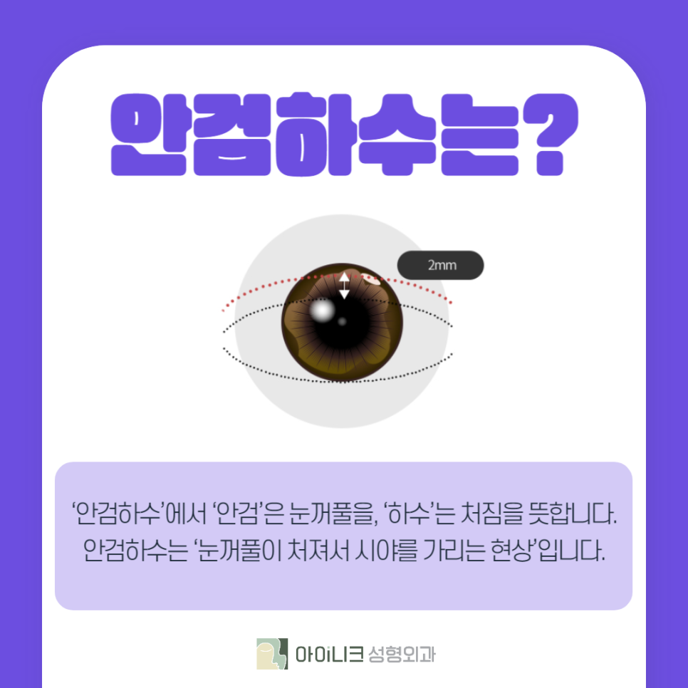 40대안검하수 고려하고 있다면 관련 이미지 3