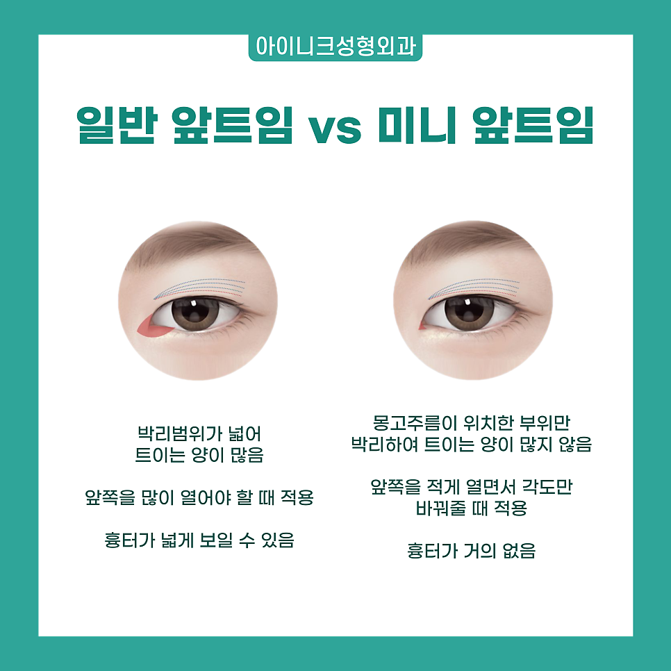 앞트임전후 확실한 인상의 변화를 원한다면 관련 이미지 3