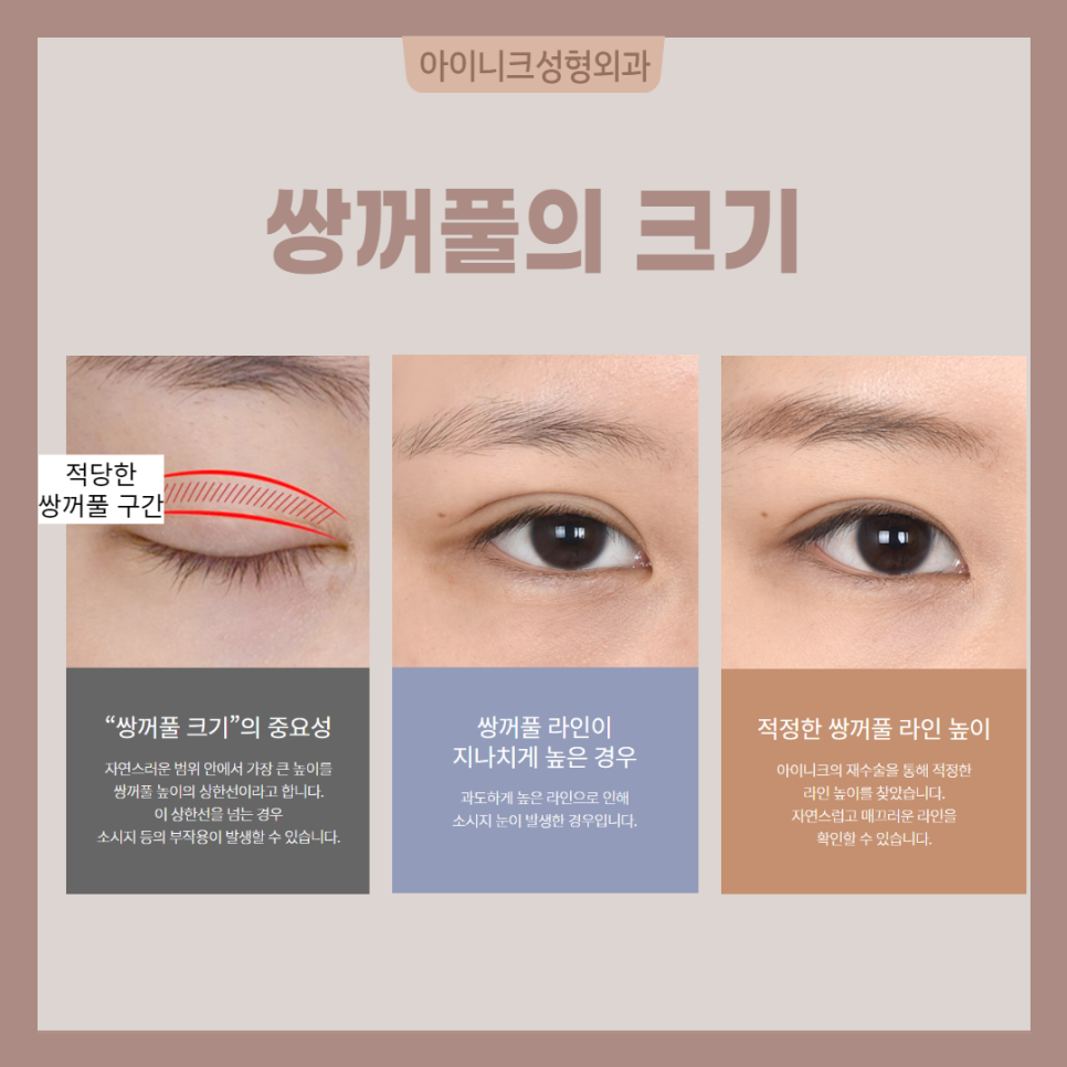 연예인눈성형처럼 자연스럽고 싶다면? 관련 이미지 3
