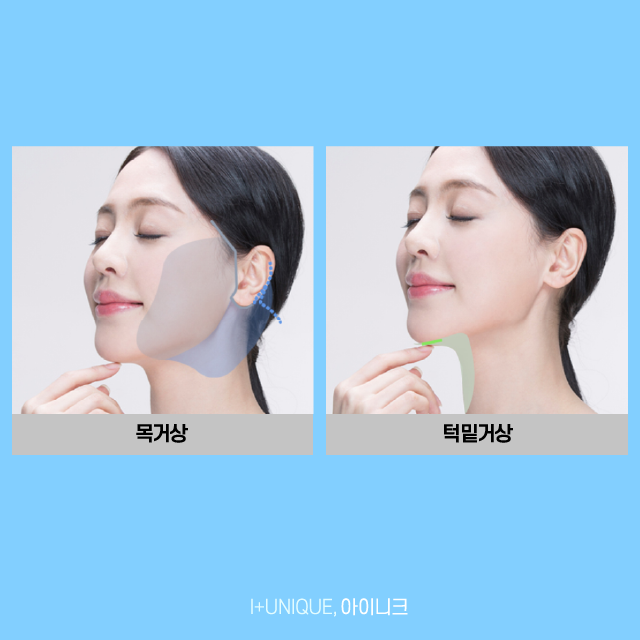 Finding the Right Revision Facelift Method for Me, from the Face to Under the Chin image 4