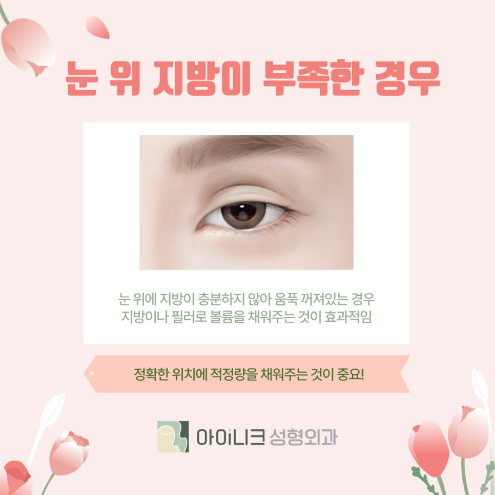 눈성형재수술 성공적으로 하기 위해서는? 관련 이미지 6