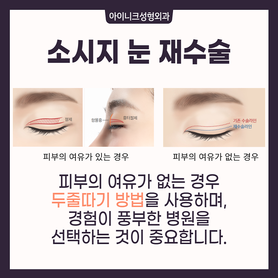 소세지쌍꺼풀재수술, 고민한다면 관련 이미지 3