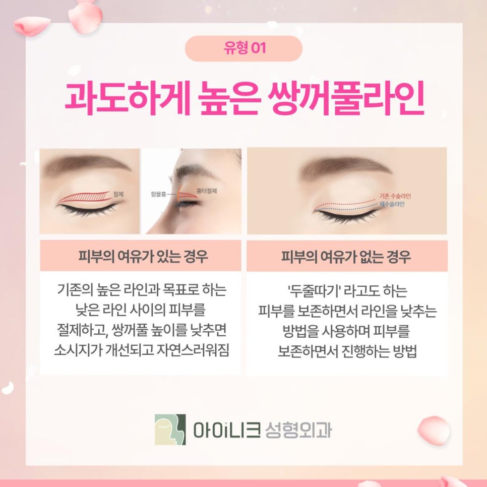 Where to Go for Revision Double Eyelid Surgery: Naturally Correcting Puffy Sausage Eyes image 4