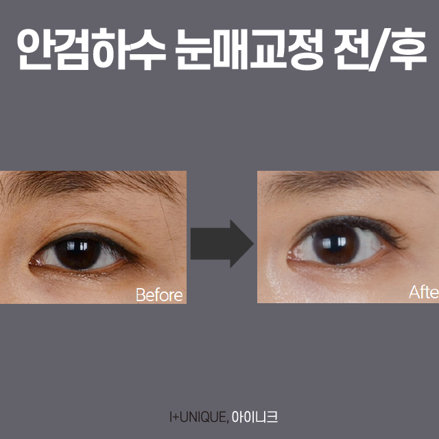 서울눈재수술추천 아이니크 성형외과에서 제대로 성공하자. 관련 이미지 3