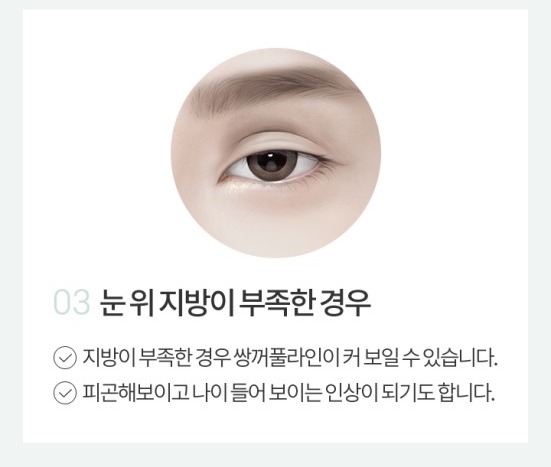 소시지눈재수술 자연스러움이 가장 중요 관련 이미지 4