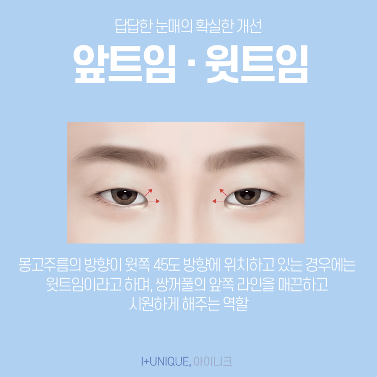 눈트임수술 어떤 것을 해야할지 고민이라면 아이니크성형외과에서 상담받자 관련 이미지 3