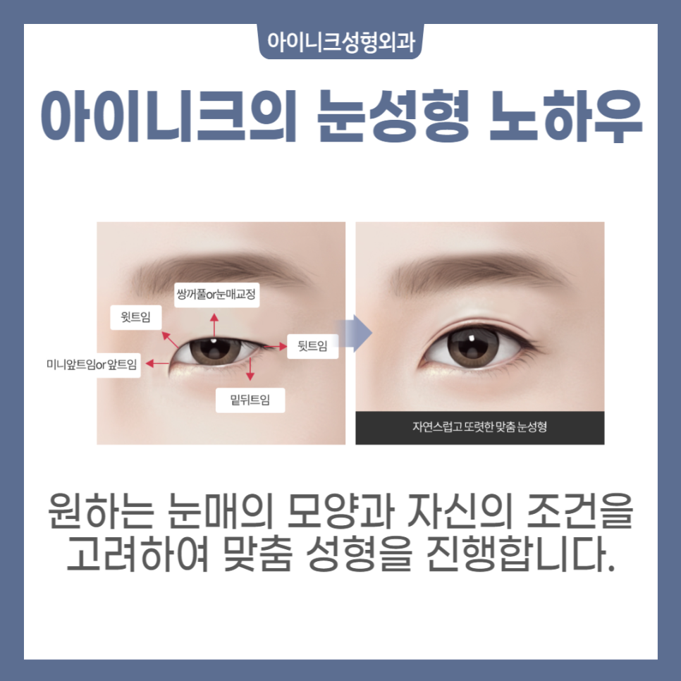 The Secret to a Natural, Clear Eye Shape with Outer Corner Surgery image 2