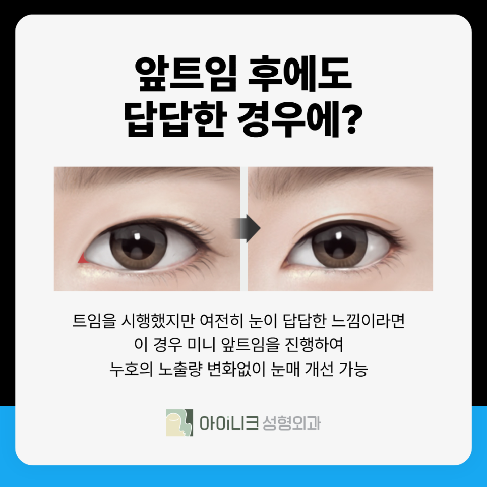 Revision Eye Surgery Clinic: What Can I Do About a Harsh Look Caused by Excessive Epicanthoplasty? image 6