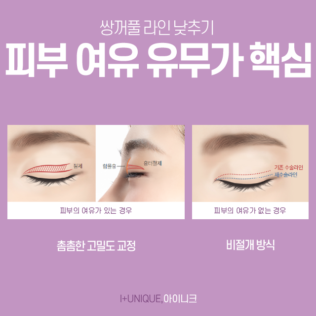 Want to Lower Your Double Eyelid Line? For Revision Surgery, Choose a Place You Can Trust! image 5